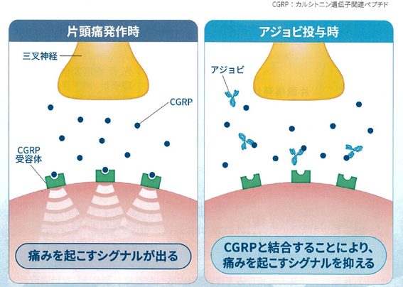 偏頭痛 片頭痛（偏頭痛）の予防注射 | 横浜フロント脳神経外科・泌尿器科